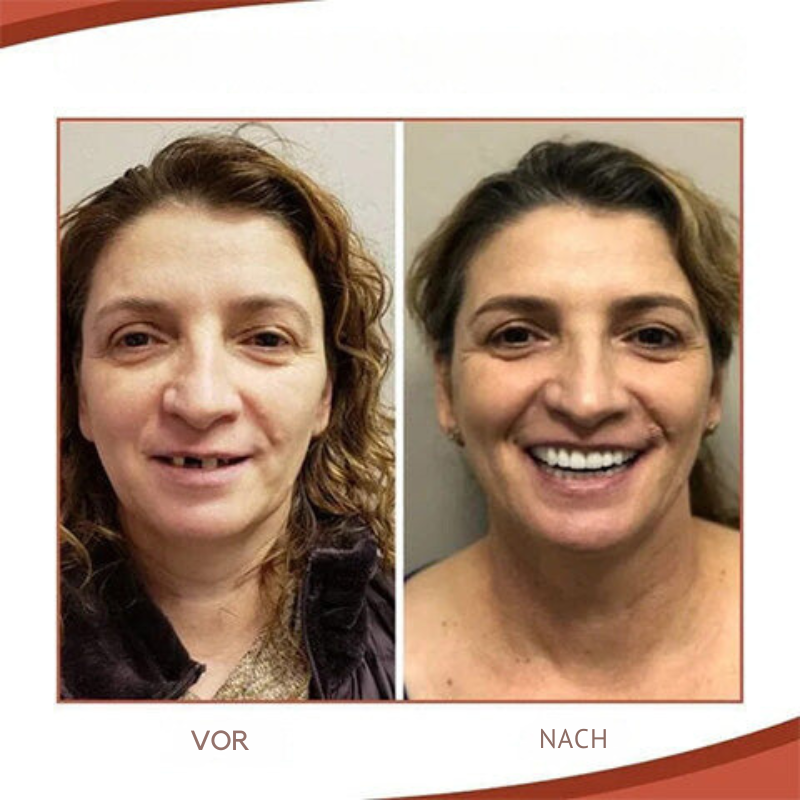 BowLift | Biocompatible Prosthesis Set for Pain-Free Fit and Natural Smile