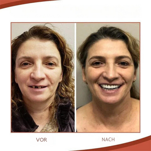 BowLift | Biocompatible Prosthesis Set for Pain-Free Fit and Natural Smile