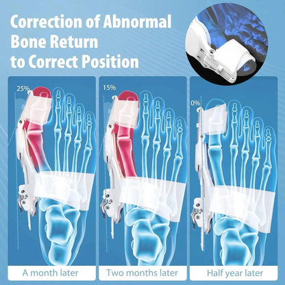 Bunion Corrector - Adjustable Bunion Splint
