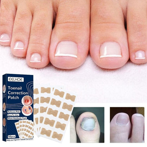 Toenail Paronychia Relief Patches (50 pcs)