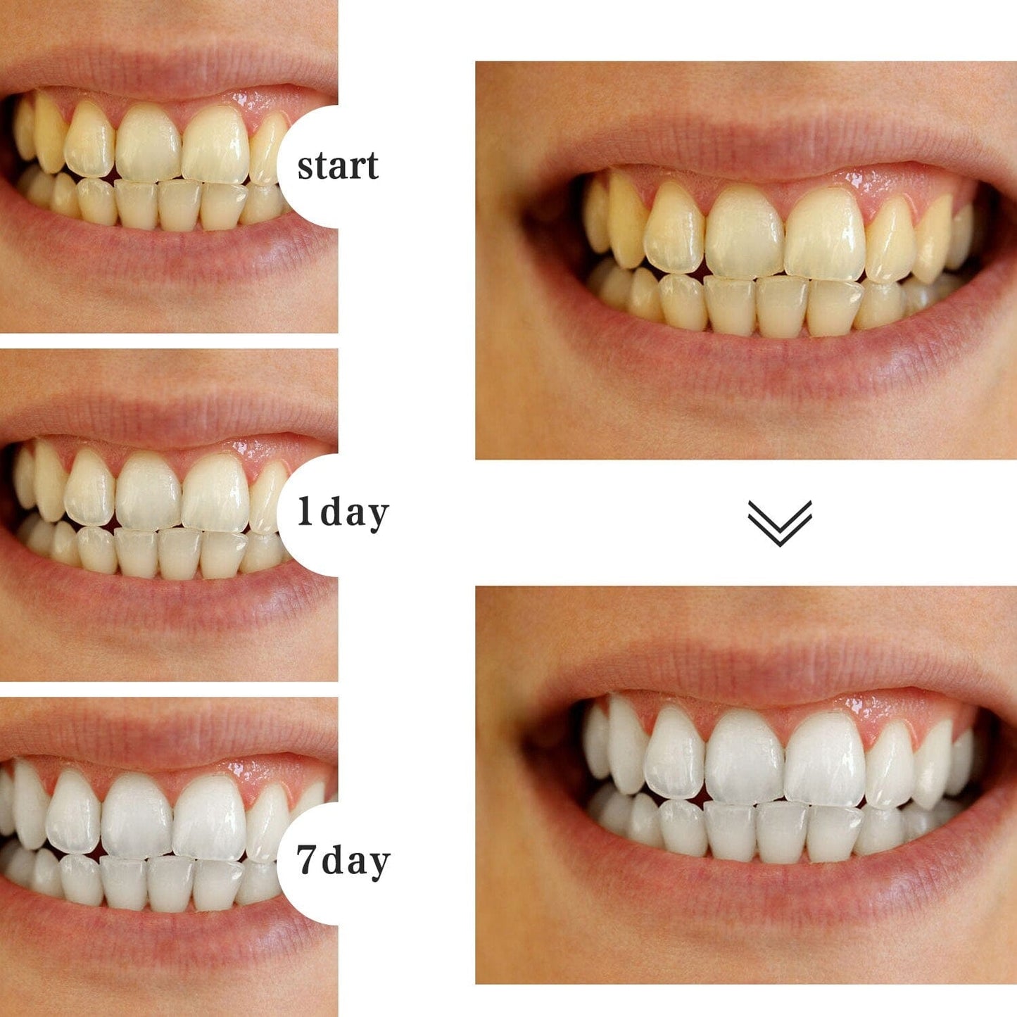 Whitening Dental Gel Pen